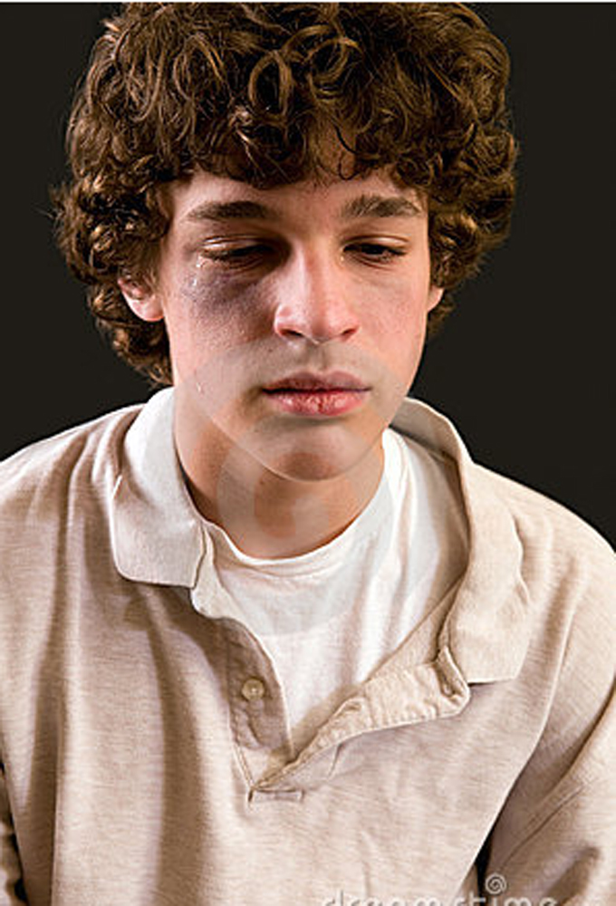 boy with shiner